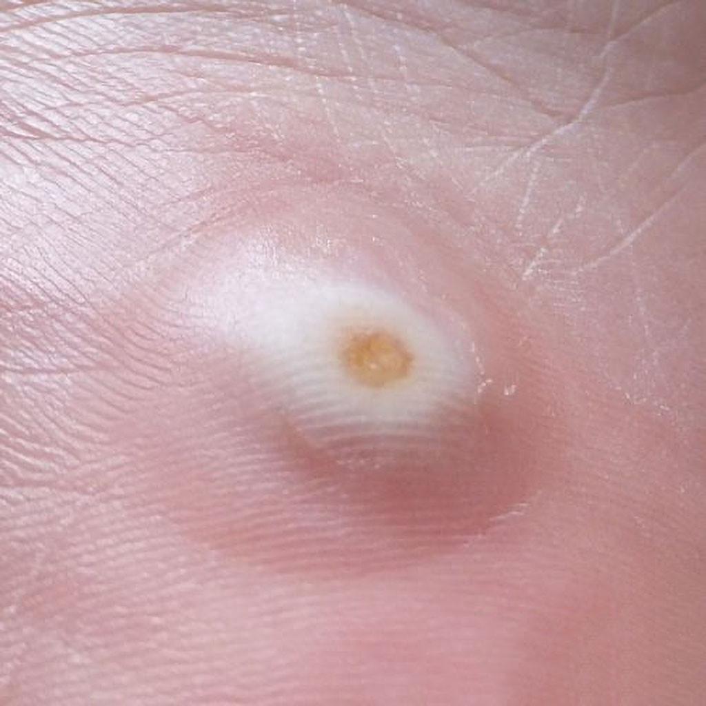 Foot Corn Remover Plaster Foot Pad Patches  Patch Pain Foot Care Tools