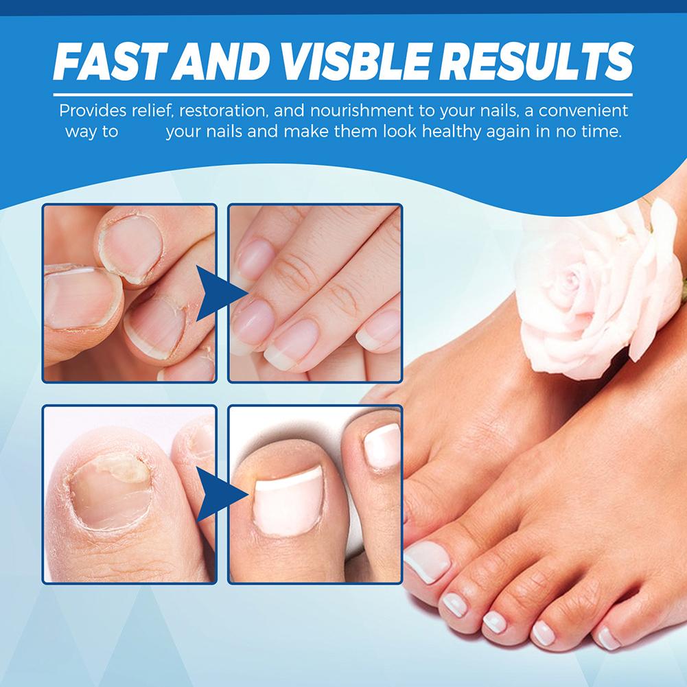 Nail Fungus Laser Cure Machine Foot Care Device for Nail Treatments Anti Infection Paronychia Onychomycosis Nail Removal Care