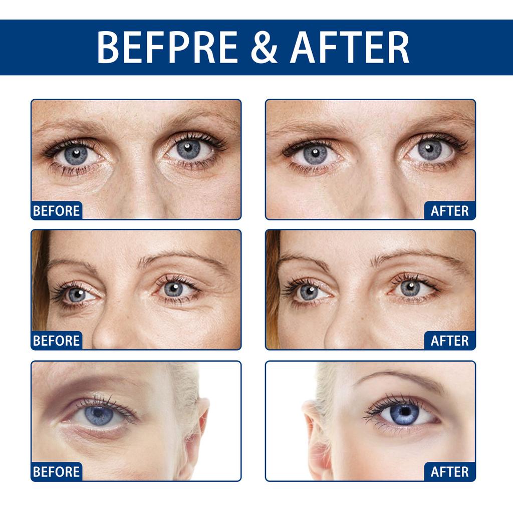 EELHOE Hyaluronic Acid Whitening Eye Cream Anti Dark Circles Eye Bags Wrinkle Removal Skin Serum Brighten Moisturizer Eyes Beauty Health