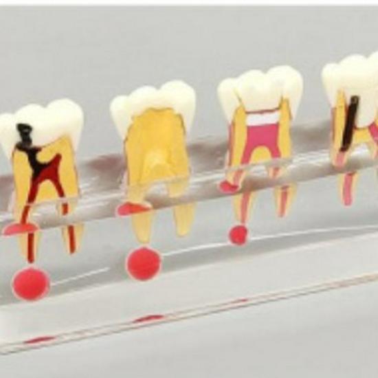 PH4018 Detachable Doctor-Patient Pulp Restoration Pathology Teaching Model