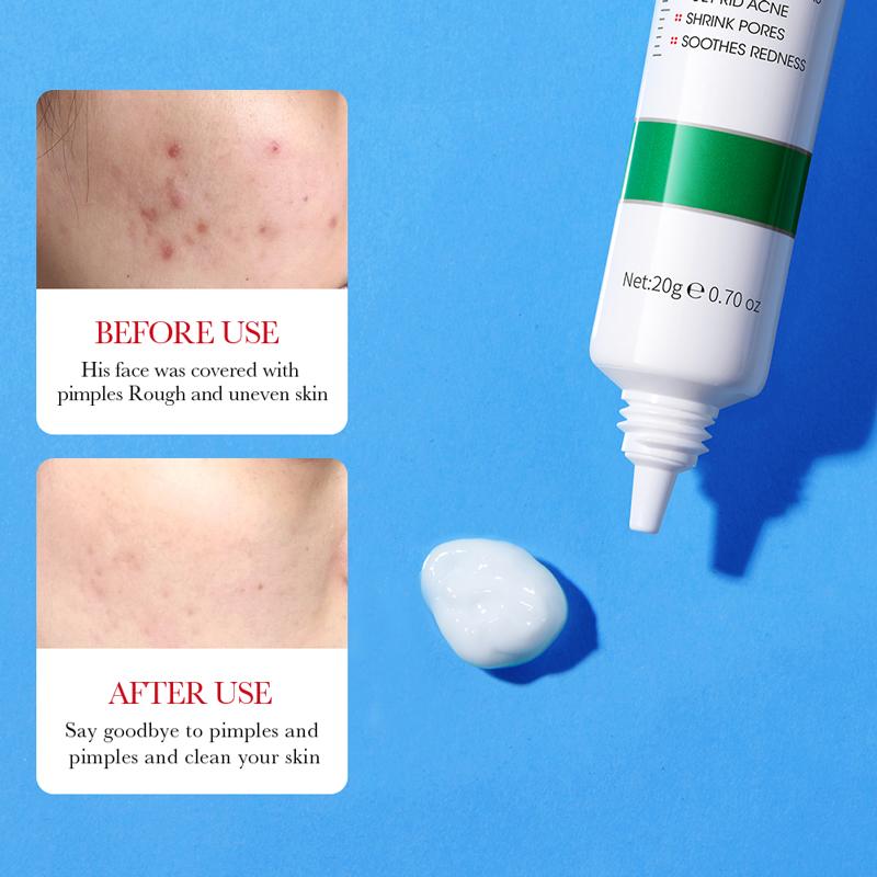 BIOAOUA Salicylic Acid Acne Cream Shrink Pore Cream Elimination Large Pores Remove Blackehead Repairing Skin Care Facial Cream