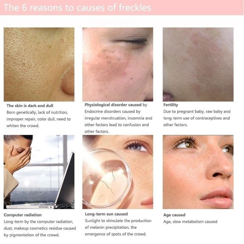 The Latest Horse Oil Freckle Cream, Fade, Stain, Sunburn, Chloasma, Freckles, Facial Care