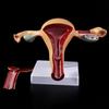 Human Pathological Uterus Ovary Model Anatomical Anatomy Disease Pathology Medical Lesion Teaching