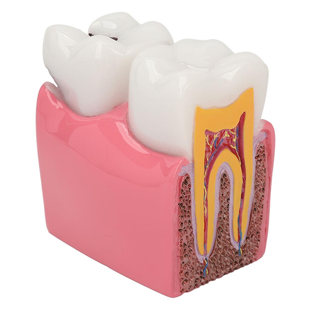 Dental Caries Model Tooth 6X Decay Demonstration Model for Teaching Study Laboratories