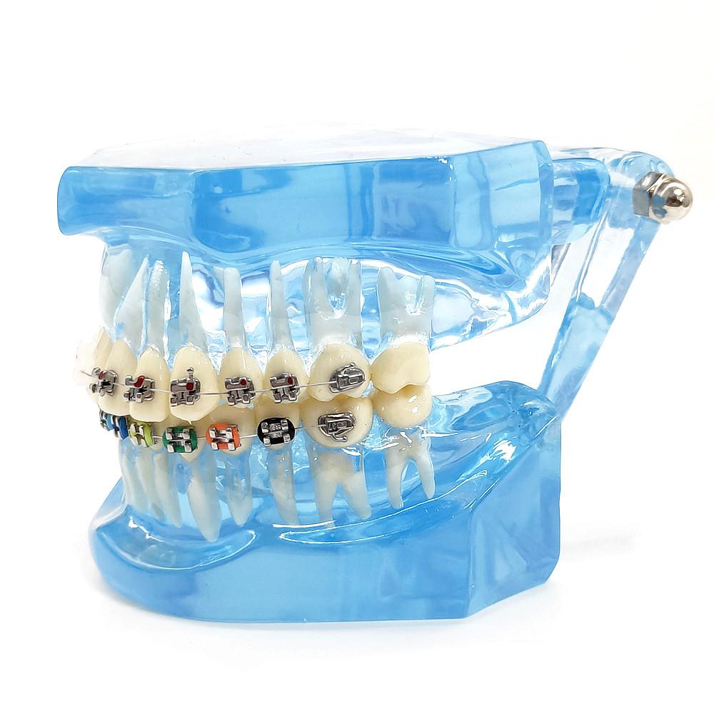 Dental Orthodontic Teeth Tooth Model 4 Kinds Brackets Ceramic and Metal Brackets for Patient Communication Dental Study Model