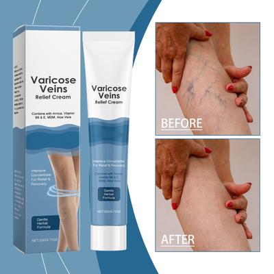 Varicose Vein Relief Cream Leg Massage Care Massage, Blue Veins And Red Blood Vessels  Varicose Veins,  Leg Fatigue And Soreness, Reduce Swelling A