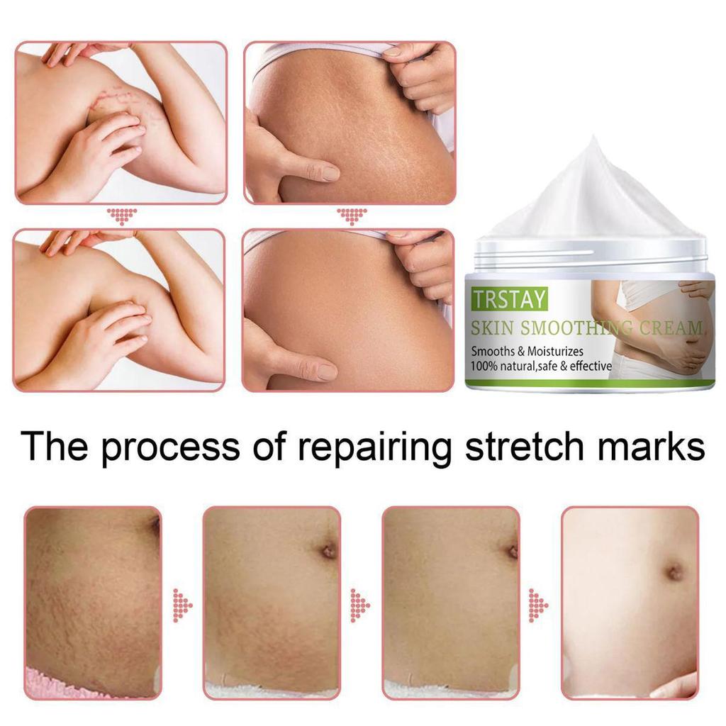 Stretch Mark Cream Pregnant Women Postpartum Stretch Marks  Crema Para Blanquear La Cara Skin Whitening Cream