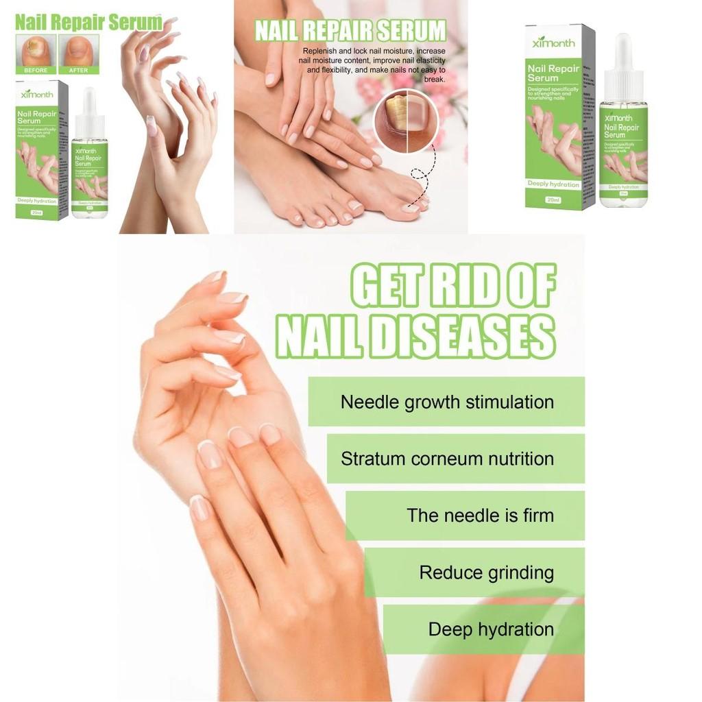 Nourishing And Revitalizing Ximonth Nail Repair Essence For Healthy Strong Nails