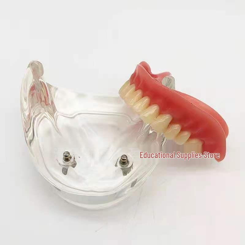 Modelo Dental de Media Mandíbula con Demostración de Implante Dental y Restauración de Dentadura Postiza