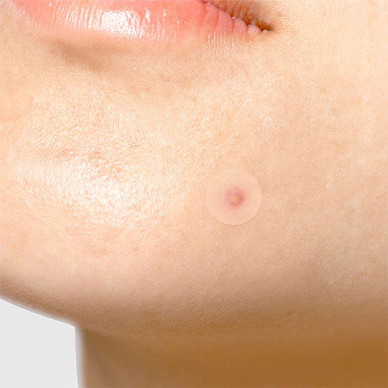 TIAM Überraschungs-B-Patch (7mm x10 Stück + 10mm x 5 Stück + 12mm x 9 Stück)