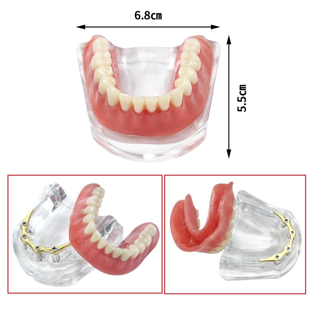Dental Teeth Model With Implants Gold/Silver Bar Type Overdenture Restoration Treatment Typodont For Dentist Patient Teaching