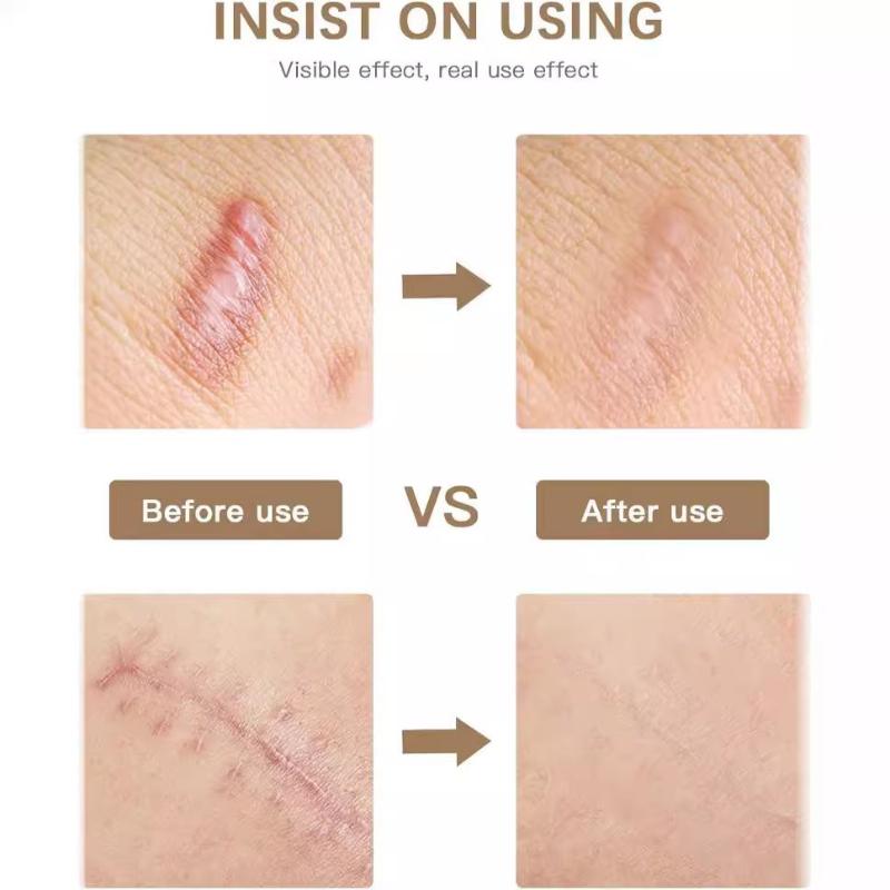 1 Roll Silicone Gel Scar Sheet Patch Treatment Removal Tape Cover Burn Trauma Repair Acne Ear Scar Section Beauty Skin