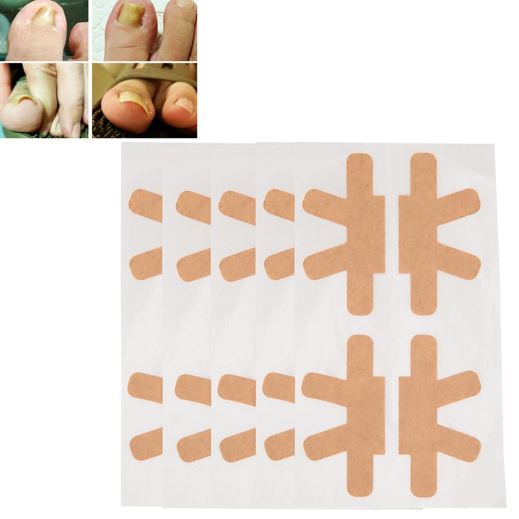 Ingrown Toenail Corrector Stickers Pedicure Toe Nail Care Correction Bandage Patch
