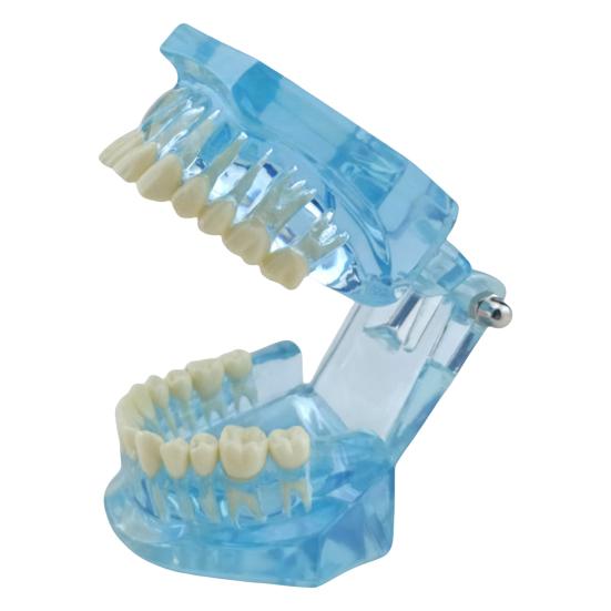 Dental Implant Model Teaching Aid for Dentist Student School Removable Teeth