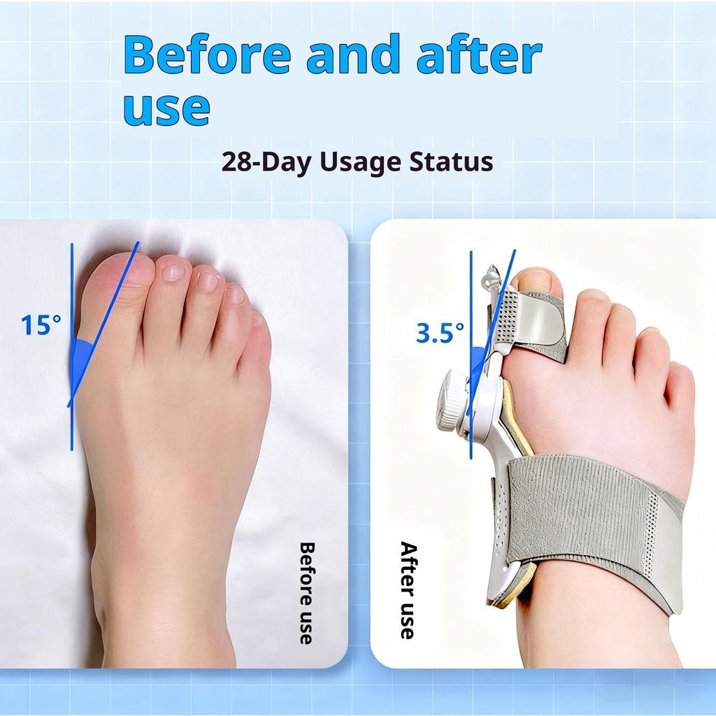 Teenspreider Bunion Corrector Gezondheidszorg Unisex Valgus Teen Correctie Pijnloze Voetbehandelingen Dikke Vinger Corrector Hoek Verstelbare Knop