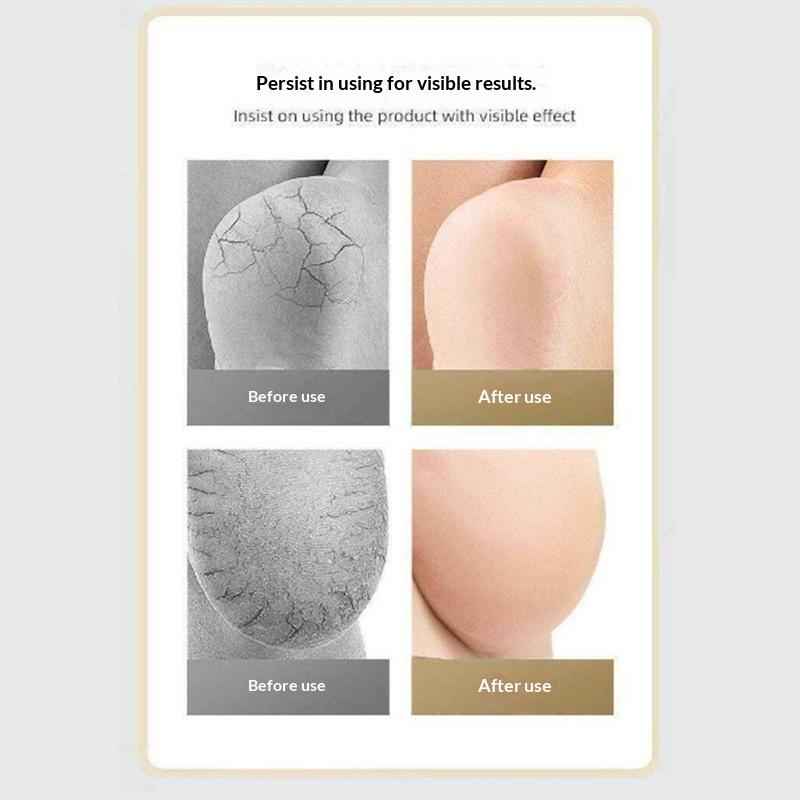 Gel Silicone Heel Protector Sleeve Heel Pads Heel Cups Plantar Fasciitis Support Feet Care Skin Repair Cushion Half-Yard Socks
