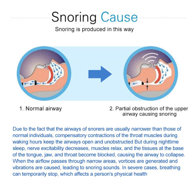 1Stk Anti-Schnarch Mundstück Gerät Zunge Medizinisch Silikon Schlafschutz Zungenhalter Atemhilfe Schnarchen Apnoe