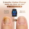 Nail Fungus Cleaning Laser Light, Used For Onychomycosis, USB Charging 905nm Infrared Light 470nm Blue Light