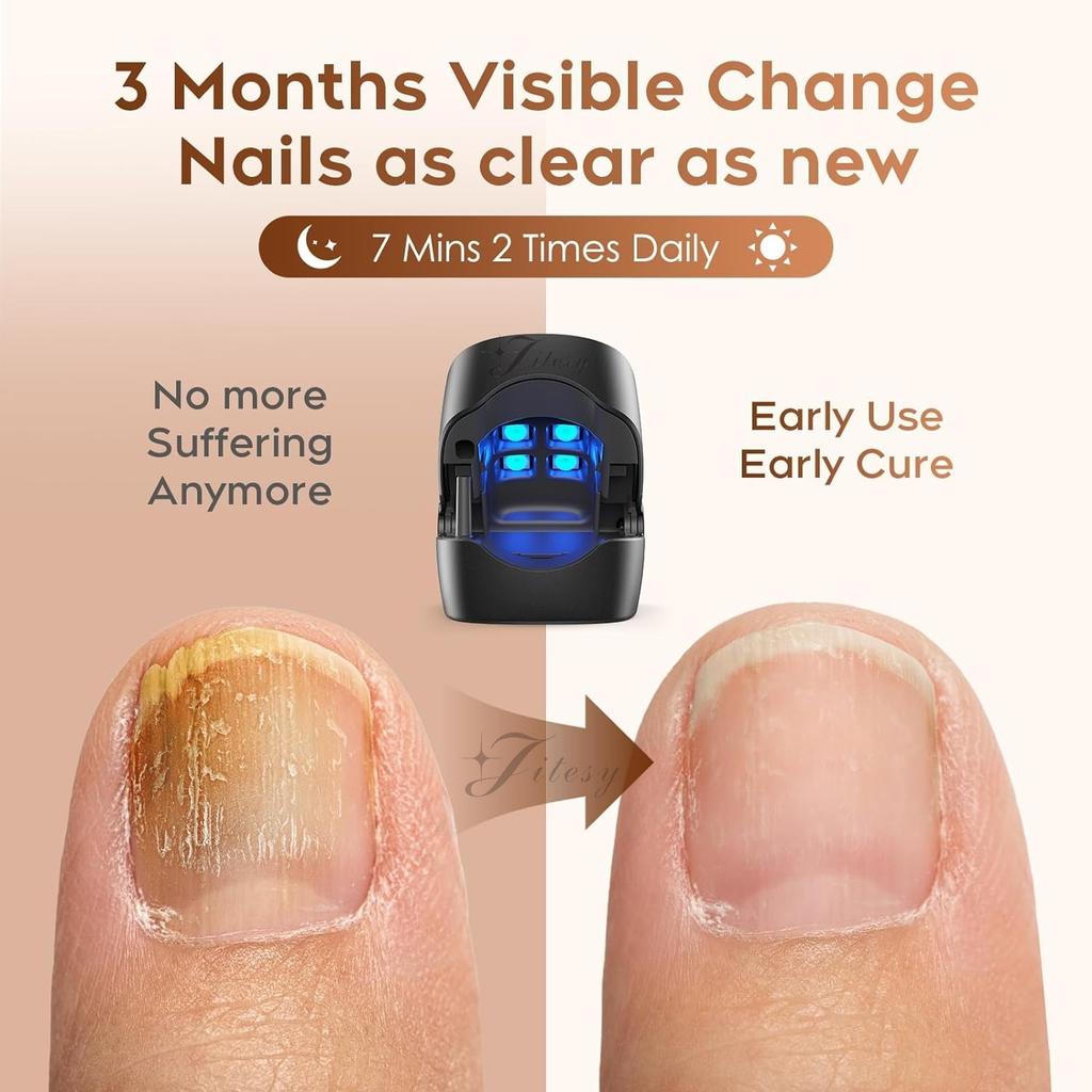 Nail Fungus Cleaning Laser Light, Used For Onychomycosis, USB Charging 905nm Infrared Light 470nm Blue Light