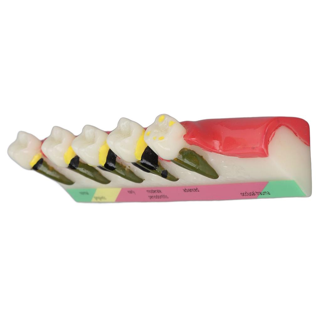 Dental Teeth Model Ceramic Clear Structure Oral Care Educational Periodontal Disease Model