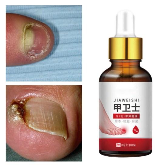 Nail Antibacterial Solution Disinfection Herbal Ingredients Synthetic Toenail Fungal Treatment Liquid for Feet Care