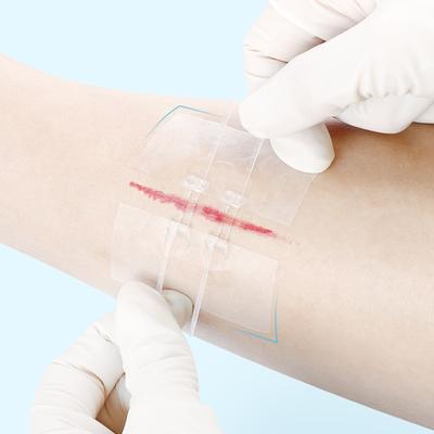 1/2 ks Zipová náplast na uzavření rány Hemostatická náplast Rychlé sešití rány Zipová náplast Venkovní přenosná