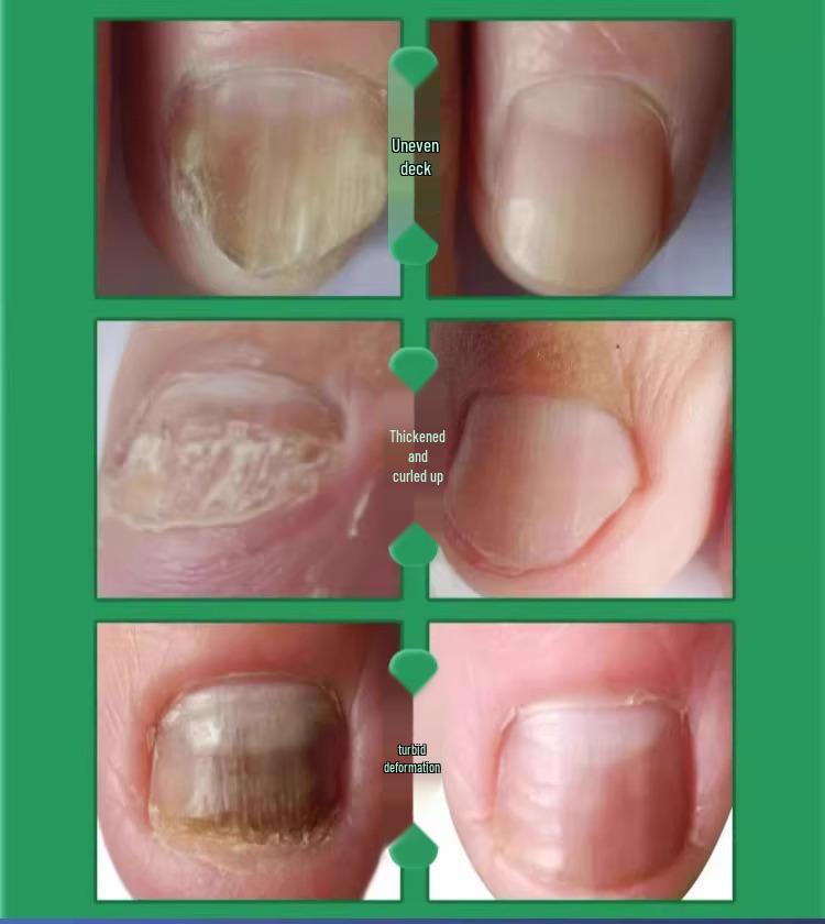 Electric Toenail Grinder & Polisher for Thick Nails