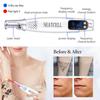 Picosecond Laser Pointer for Mole Removal Dark Spot Removal Pen Portable Beauty Device for Tattoo Acne Skin Pigment Removal