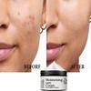Blemish Serum Cream To Reduce Fine Lines, Smooth Wrinkles and Improve Damaged Skin