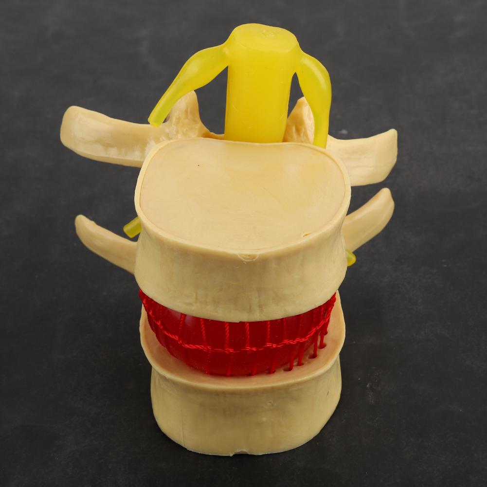 1:1.5 Lumbar Disc Herniation Demonstration Model Study Learn Human Spine