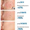 Plant Extract Acne Removal Cream Anti-Acne Repair Redness Pimple Spots Deep Cleaning Pore Oil Control Moisturizing Skin Care