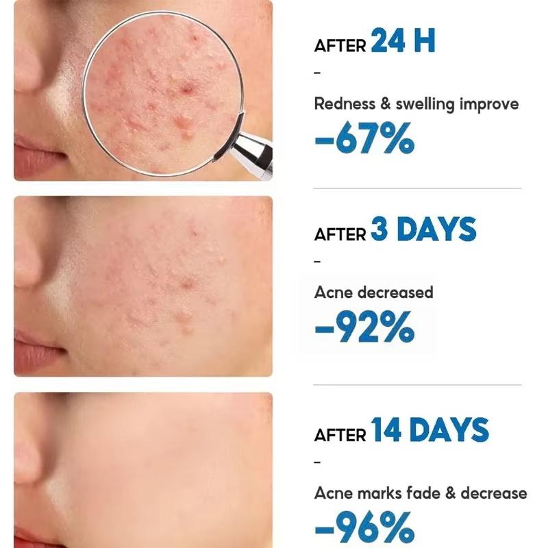 Plant Extract Acne Removal Cream Anti-Acne Repair Redness Pimple Spots Deep Cleaning Pore Oil Control Moisturizing Skin Care