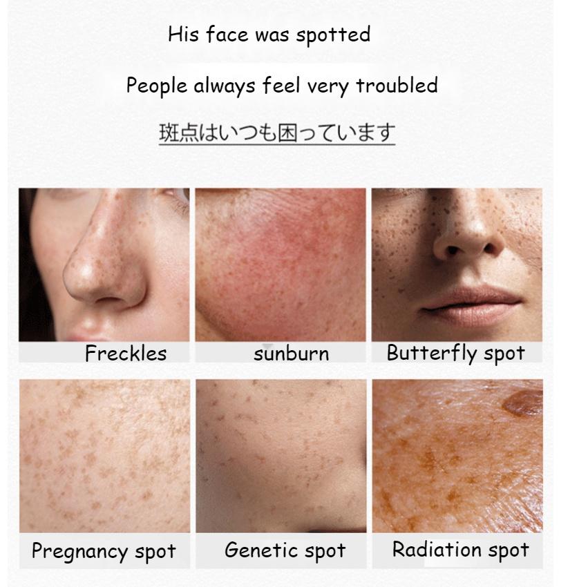 377 Whitening Cream VC Cream Freckles Chloasma Senile Plaques Beauty Salons Yellowing Cream Control Cream