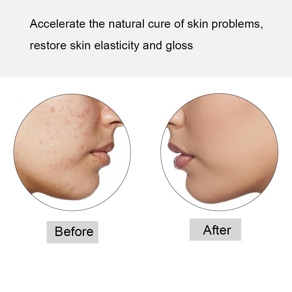 Stilou portabil cu LED pentru terapie luminoasă pentru îndepărtarea coșurilor, instrument de reparare a pielii