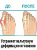 Valgomed gel with valgus deformation