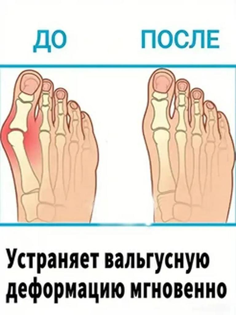 Valgomed gel with valgus deformation