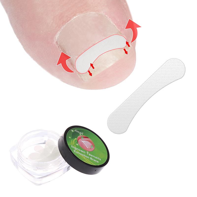 10 Stück eingewachsener Zehennagel Korrekturwerkzeug Richtclip Spange Eingewachsener Zehennagel Behandlung Elastisches Pflaster Aufkleber Pediküre Werkzeug