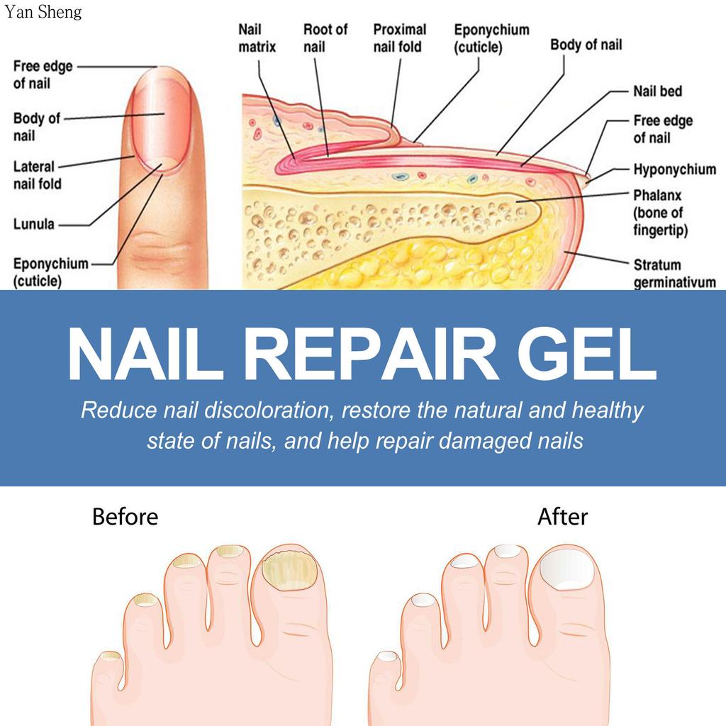 Nail Care Gel Hand Foot Onychomycosis Soft Nail Thickening Nail Luminescent Nail Repair Gel