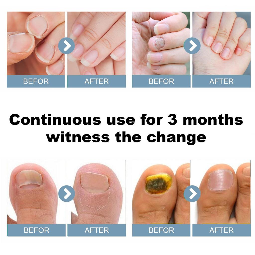 Nail Fungus Cleaning Laser Light, Used For Onychomycosis, USB Charging 905nm Infrared Light 470nm Blue Light