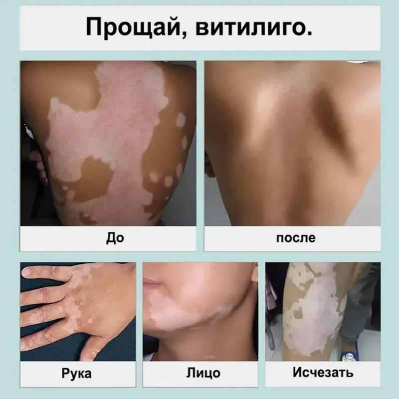 Vitiligo Relief Cream, Skin Care Cream, Vitiligo Cream, Improves Dryness, Suitable For All Skin Types