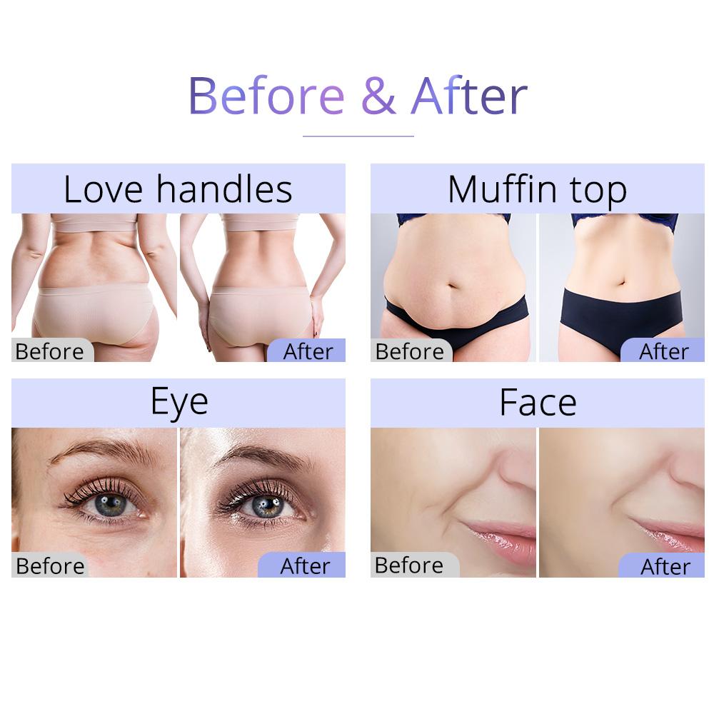 80K Cavitation 6 In 1 Ultrasonic RF Vacuum Machine