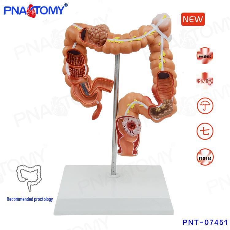 Human Colon and Anorectal Lesion Anatomy