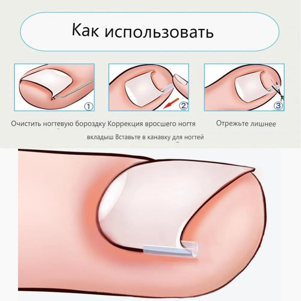 20PCS Ingrown Nail Filling Pad Sleeve Nail Pad C-shaped Nail  Pad Ingrown Nail Corrector Pedicure Tool