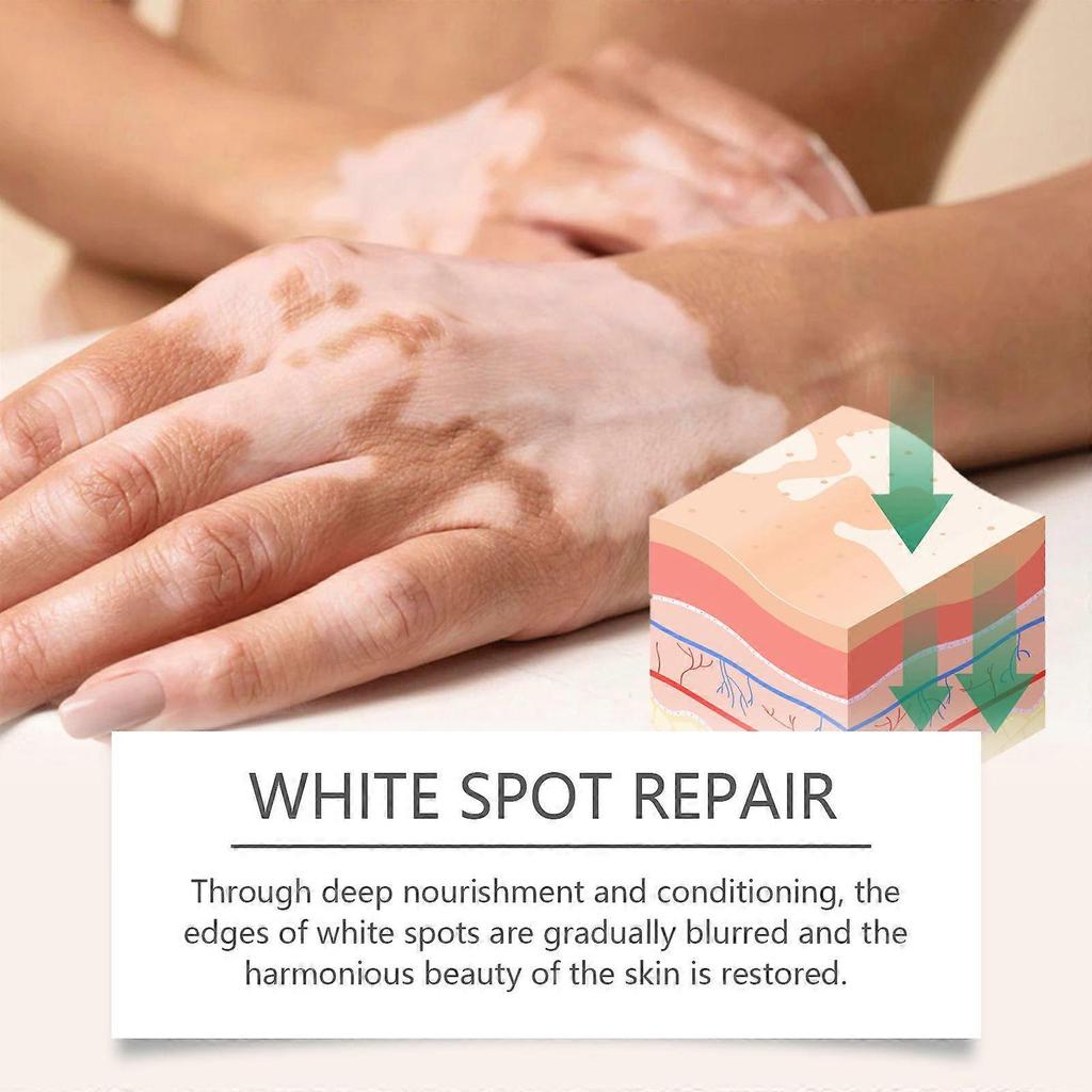 2025 Latest Model  Body Care Cream, Relieve Itching And Swelling Of Hands And