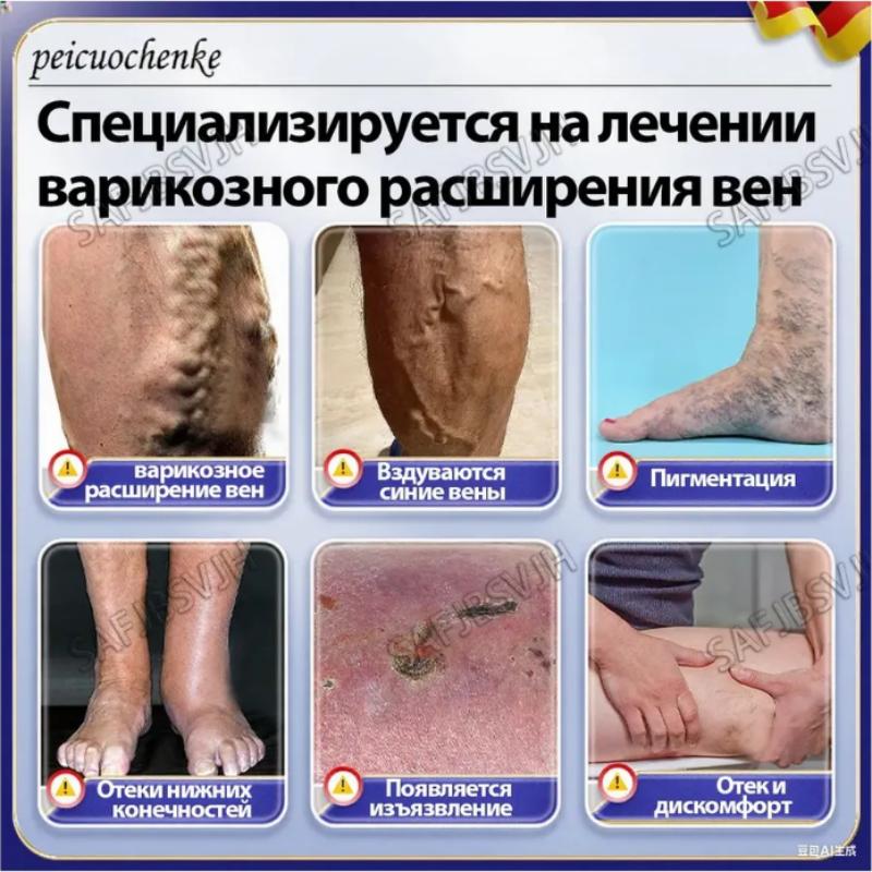 Chinese Varicose Vein Ointment for Legs, 50g