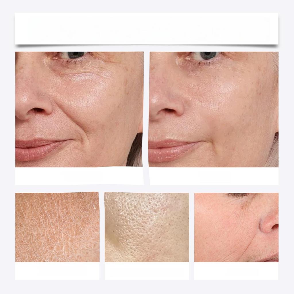 פנים הידרה רולר Microneedles מחט יופי מקצועית פנים Dermaroller נקבובית להדק אנטי אייג'ינג כלי טיפוח עור ללא כאבים