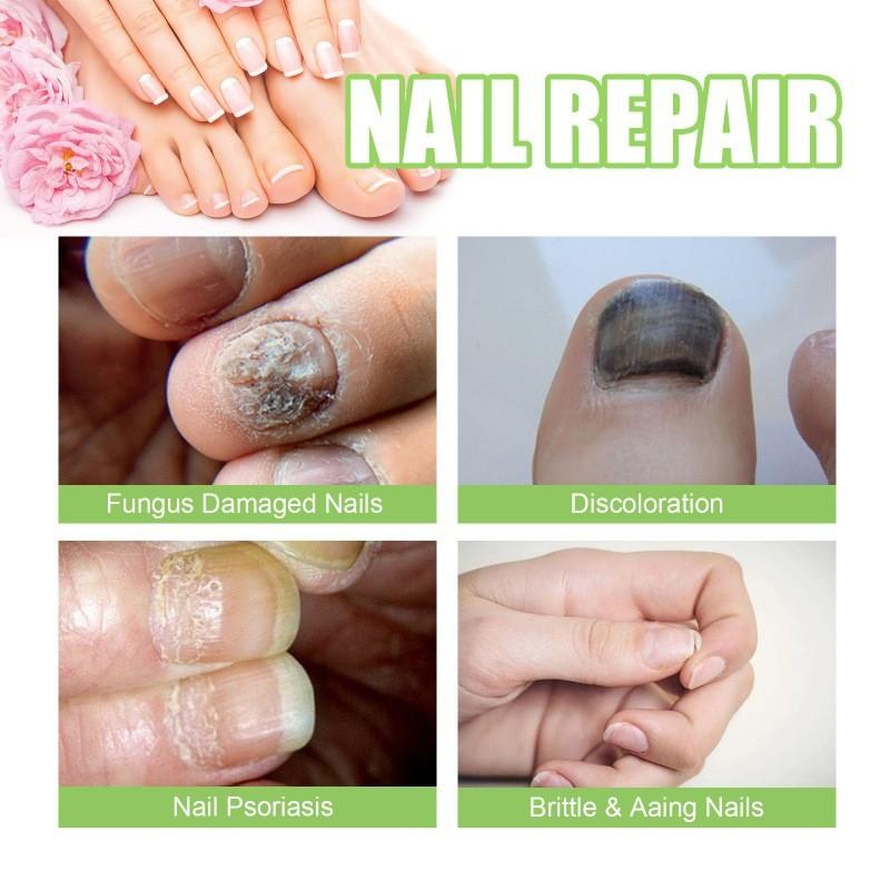 Nourishing And Revitalizing Ximonth Nail Repair Essence For Healthy Strong Nails