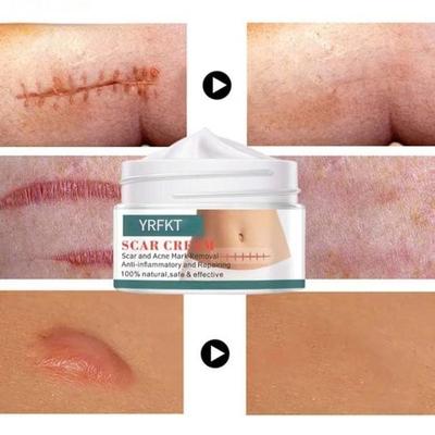 Deeply Permeate Cuticle Skin Care Acne Stretch Scar Cream