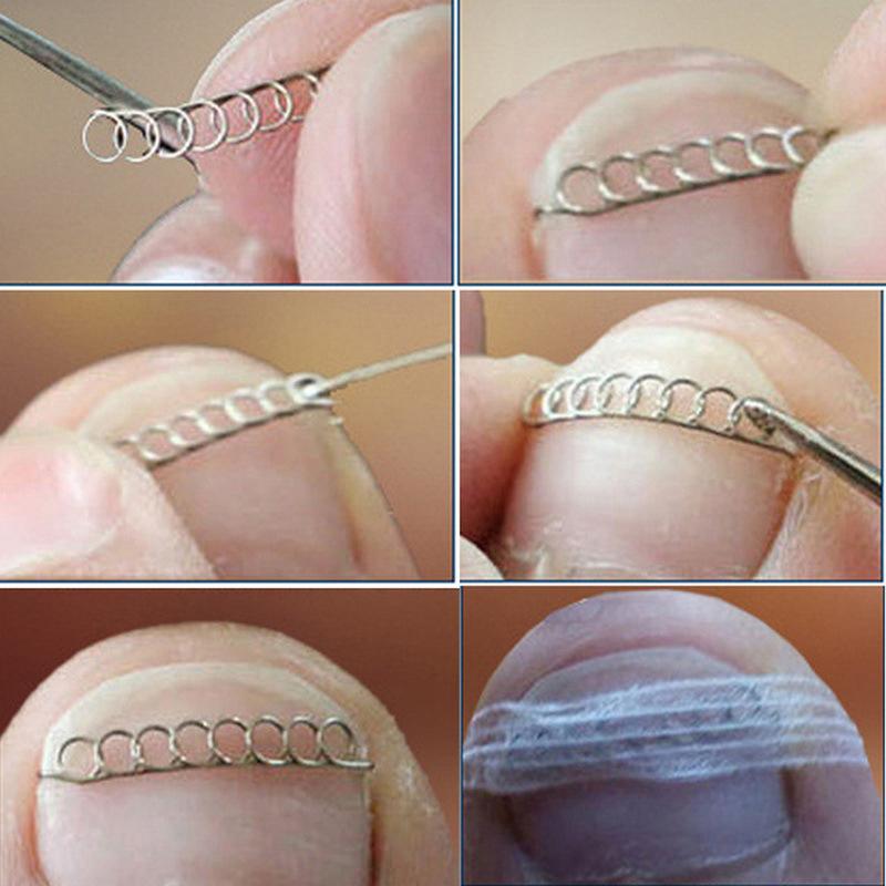Ingrown Toe Nail Correction Wire Fixer Pedicure Paronychia Recover Toenails Corrector With Toe Correction Files Foot Care Tool