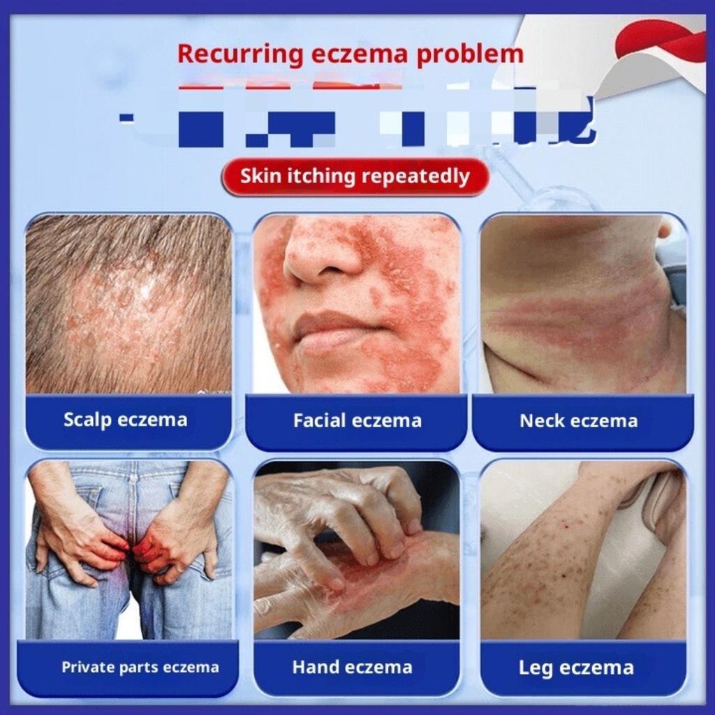 Eczema and Dermatitis Ointment This ointment helps remove dampness relieve itching, and can be used externally Ointment for fungal infection